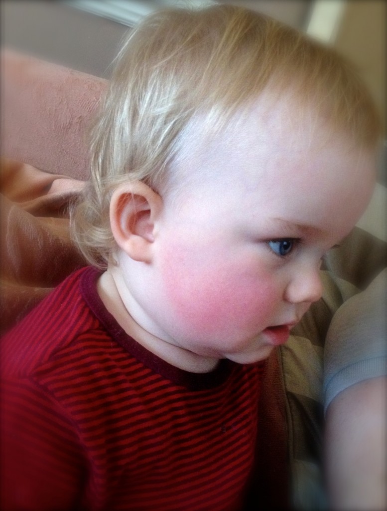 Rosy red cheeks to match his top. Poor little guy!